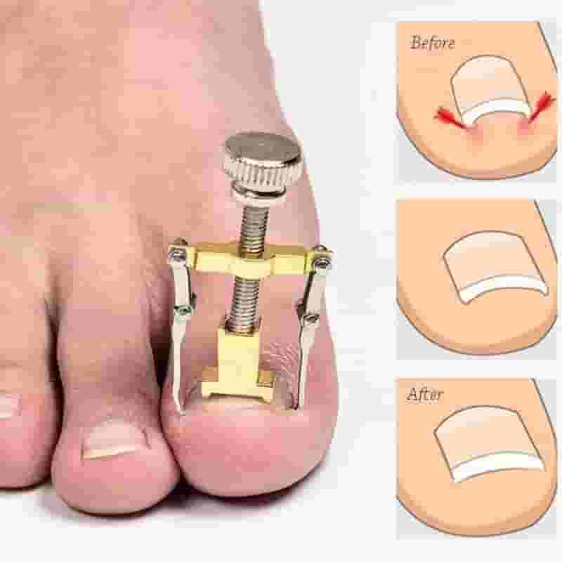 The new nail correction device 