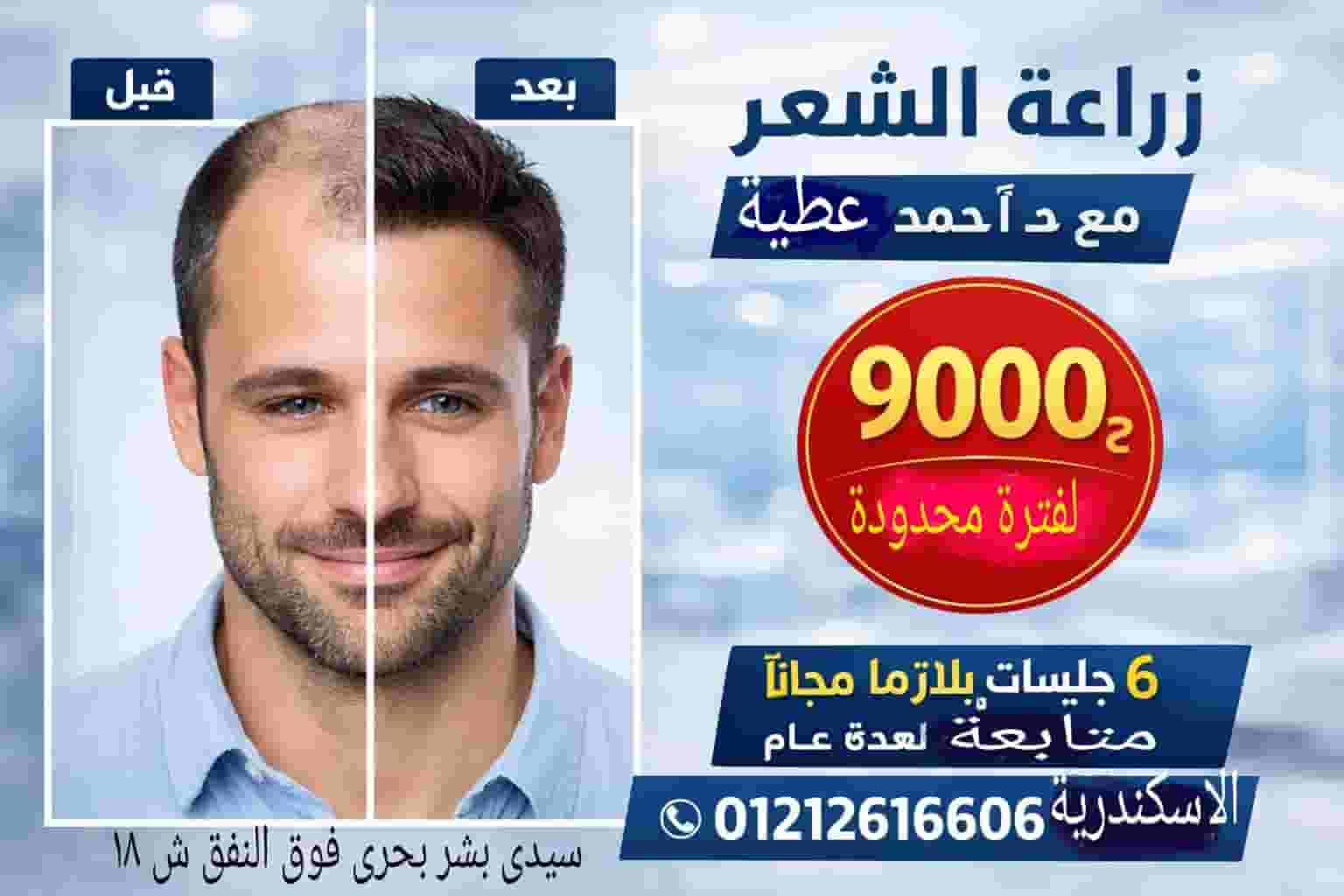 عرض زراعة الشعر لفترة محدودة
